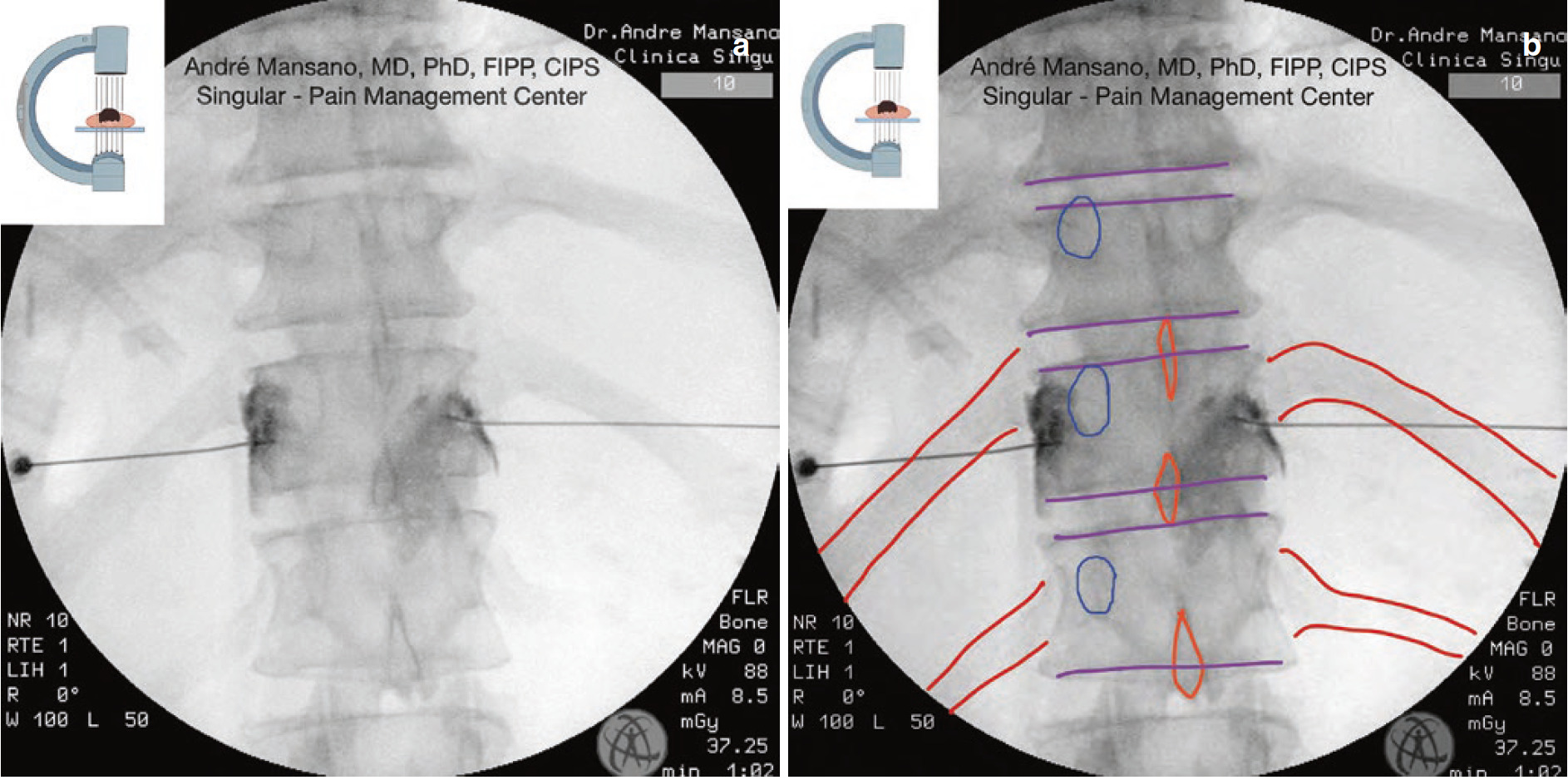 Splanchnic Block and Radiofrequency Ablation NYSORA