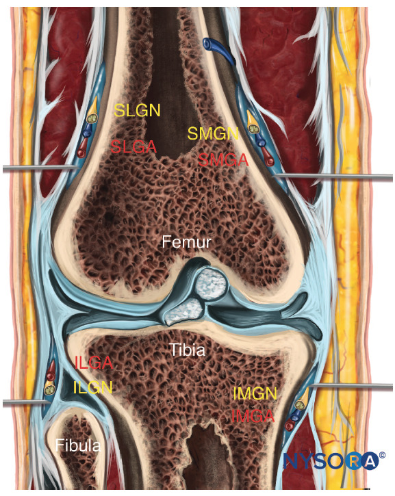 Lower Extremity Nerve Blocks Poster (in)