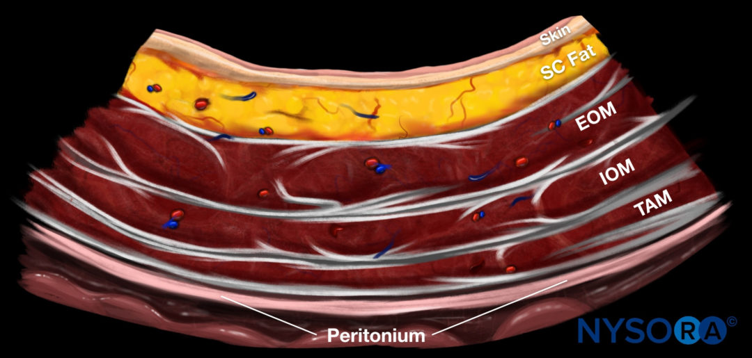 UltrasoundGuided Transversus Abdominis Plane (TAP) Block NYSORA NYSORA