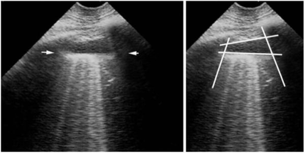 PLAPS and Pleural Effusion - NYSORA