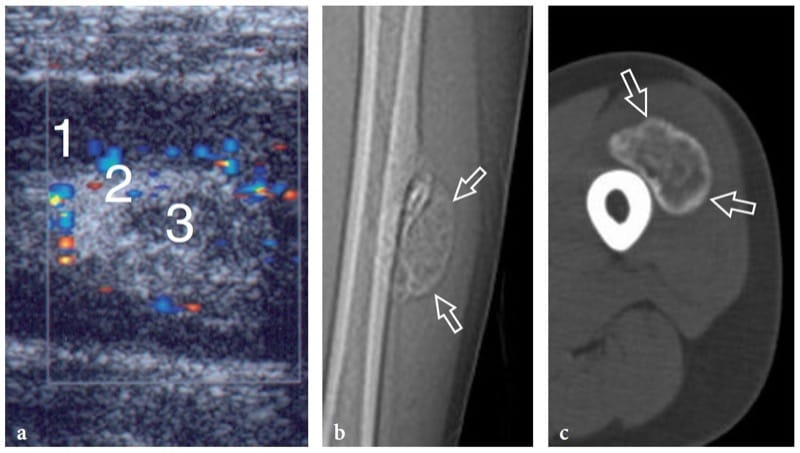 Muscle hernia in a 40-year-old man with a tender palpable mass at