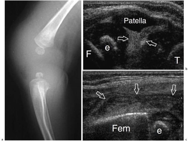 Arthrose du genou : une nouvelle thérapie cellulaire injectable fait ses  preuves