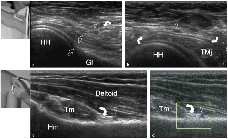 A) A subcutaneous 6-cm cord-like structure in the upper outer quadrant
