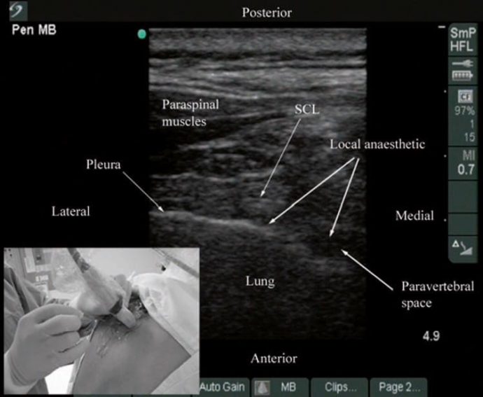 Ultrasound-Guided Thoracic Paravertebral Block - NYSORA