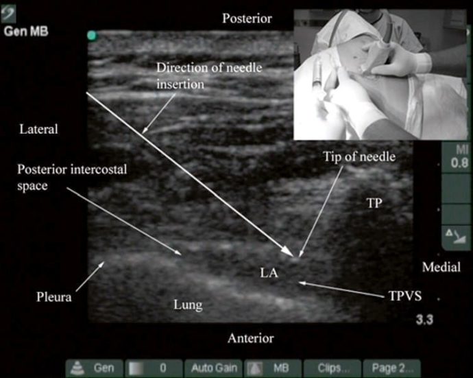 Supporting Block Radiology Different Approaches To Ultrasound-Guided Thoracic Paravertebral Block ...