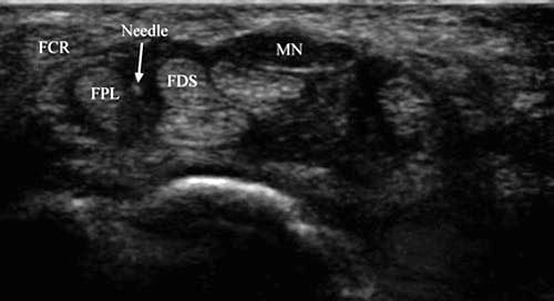 Ultrasound-Guided Hand, Wrist, and Elbow Injections - NYSORA