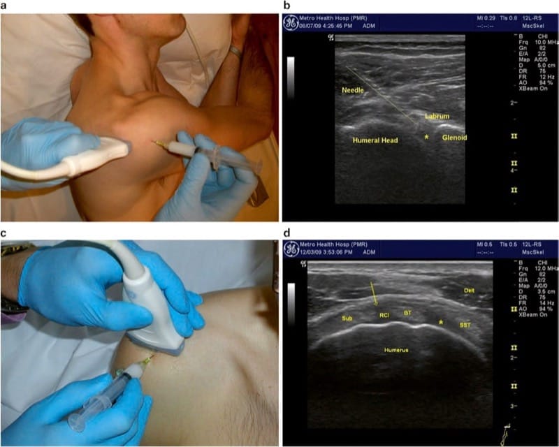 Ultrasound-guided injection for the diagnosis and treatment of