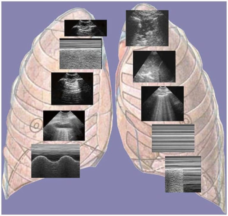 Los Siete Principios De La Ecograf a Pulmonar NYSORA