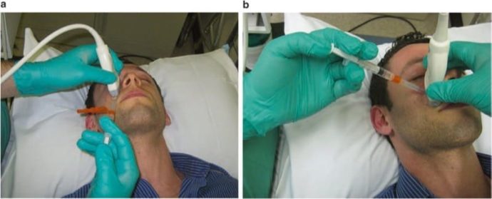 Ultrasound-Guided Superficial Trigeminal Nerve Blocks - NYSORA