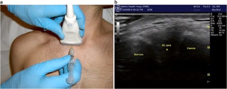 Ultrasound-Guided Shoulder Joint and Bursa Injections - NYSORA