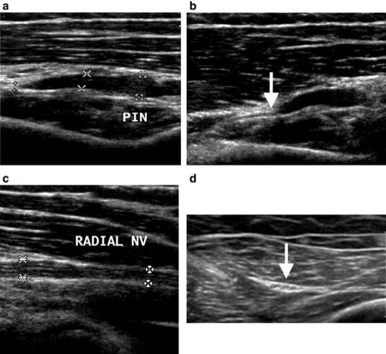 Ultrasonography of Peripheral Nerves - NYSORA