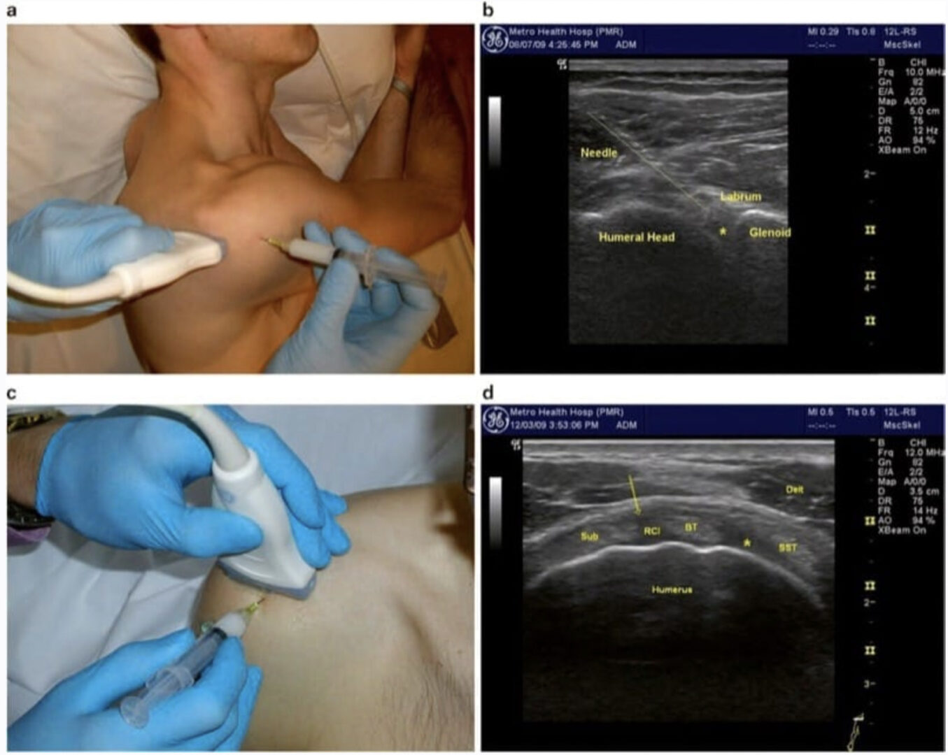 Ultrasound-guided injection for the diagnosis and treatment of