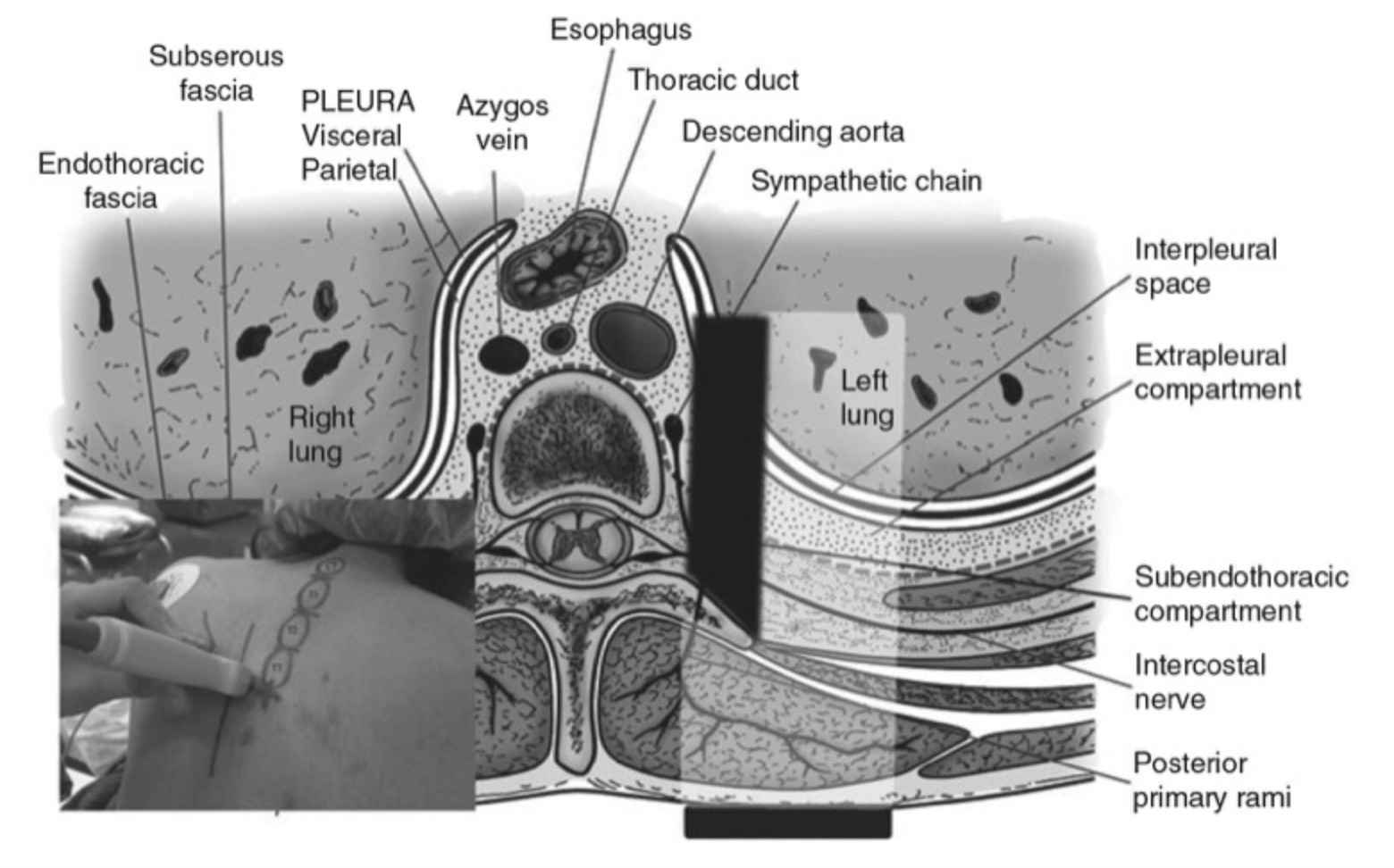 Bloc paravertébral thoracique guidé par ultrasons - NYSORA