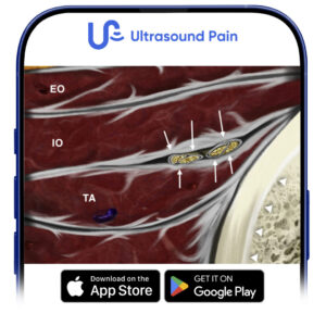 Ultrasound-Guided Blocks for Pelvic Pain - NYSORA