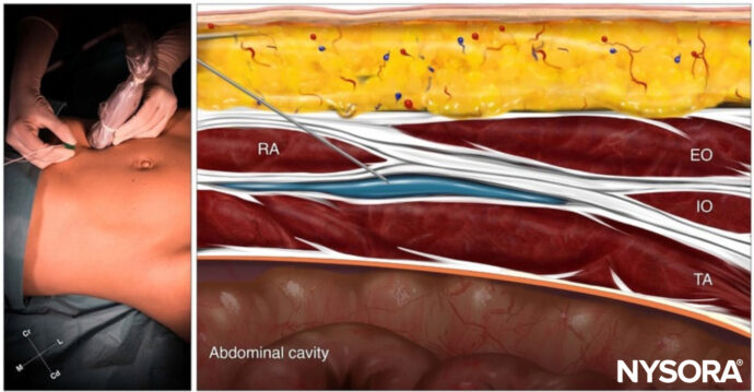 Ultrasound-Guided Transversus Abdominis Plane (TAP) Block - NYSORA