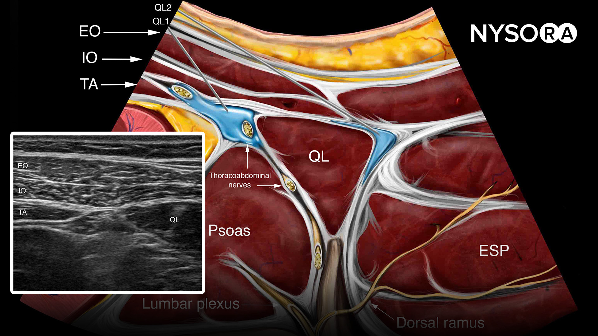 Quadratus lumborum NYSORA