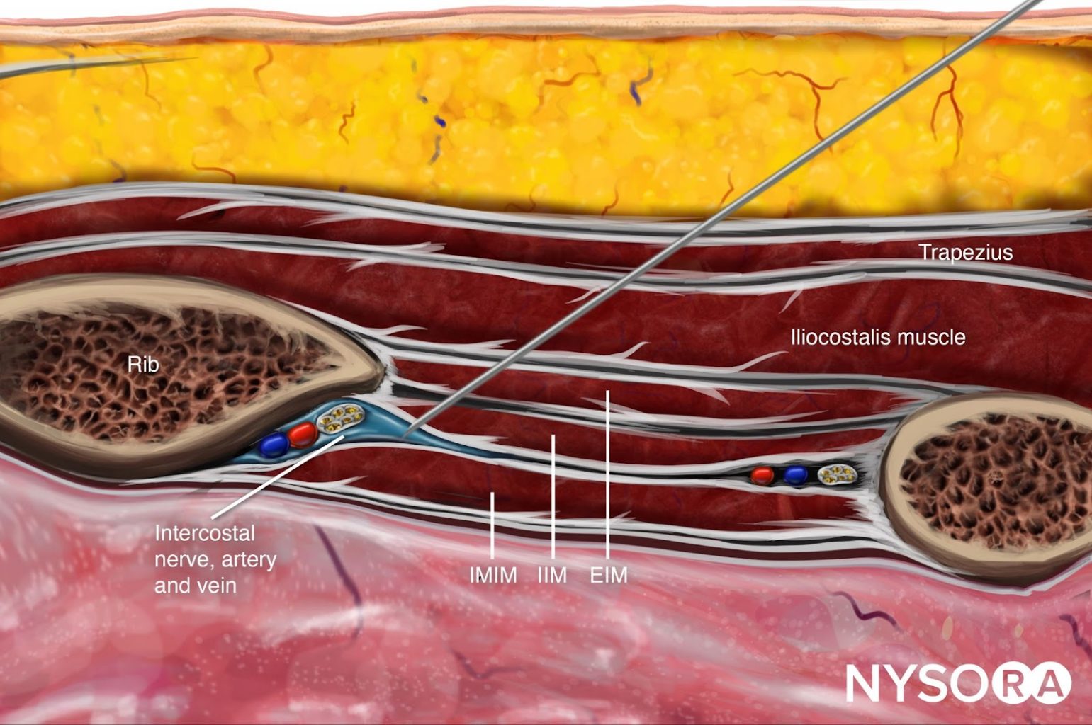 Ultrasound Pain Block Tip of the Week Intercostal Nerve Block NYSORA