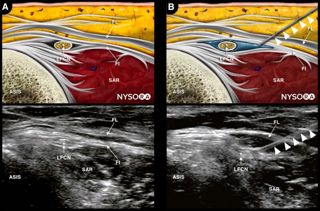 Ultrasound Pain Block Tip of the Week: Lateral Femoral Cutaneous Nerve ...