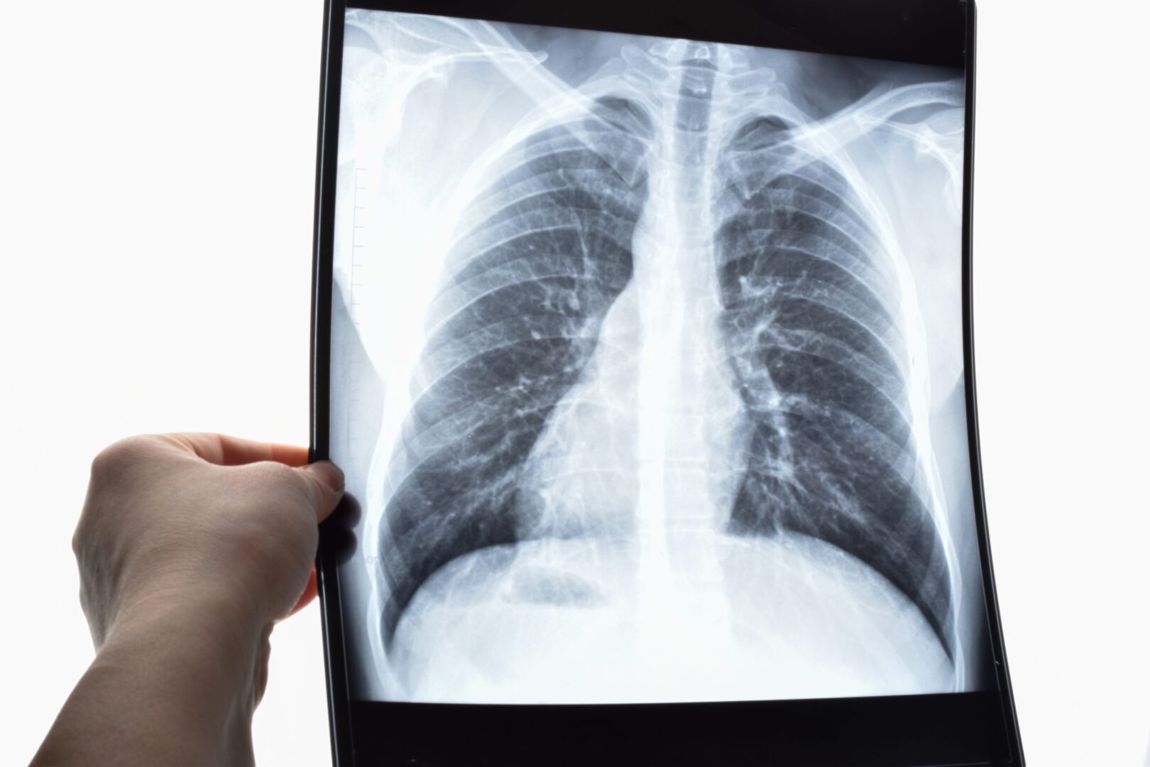 Pulmonary aspiration - NYSORA