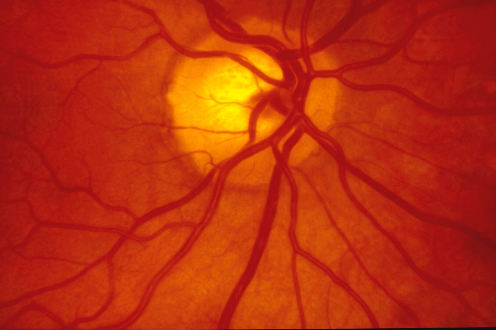 Ангиопатия сосудов головного. Диабетическая ретинопатия глазное дно. Диабетическая ангиопатия сетчатки глаза. Слсудв сетчатки.