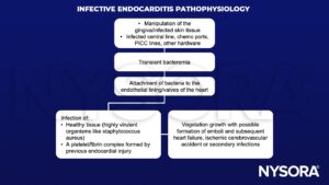 infective endocarditis, pathophysiology, bacteremia, endothelium, endothelial lining, valve, heart, staphylococcus aureus, platelet, fibrin, complex, vegetation growth, emboli, heart failure, ischemic cerebrovascular accident, infection