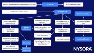 cleft lip, cleft palate, pathophysiology, dental abnormalities, suckling difficulties, speech difficulties, otitis media, conductive hearing loss, vesopharyngeal incompetence, Eustachian tube