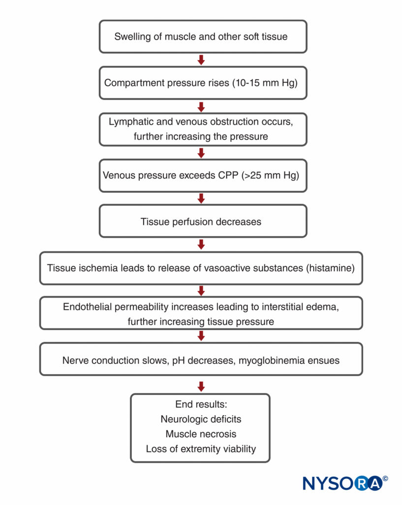 Compartment syndrome NYSORA