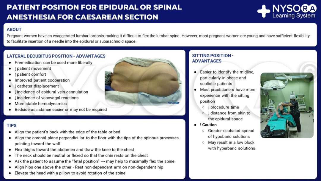 Patient position for epidural or spinal anesthesia for cesarean section