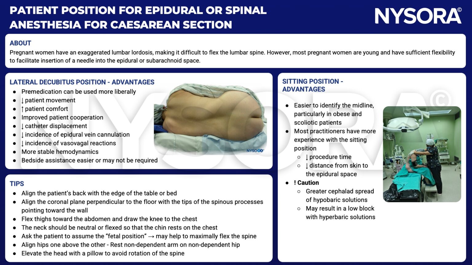 Patient position for epidural or spinal anesthesia for cesarean section NYSORA NYSORA
