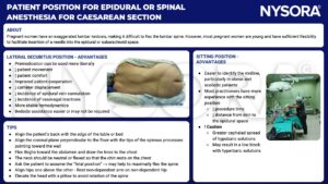 Patient position, epidural anesthesia, spinal anesthesia, lateral decubitus position, sitting position