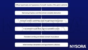 pyloric stenosis, hypertrophy, hyperplasia, pyloric sphincter, pylorus, obstruction, constriction, peristalsis, vomiting, dilated stomach, dehydration, hypochloremic alkalosis