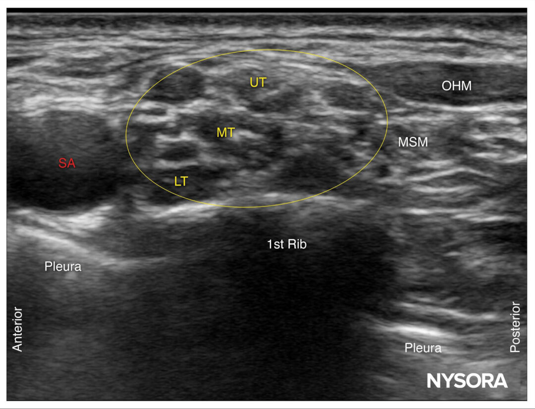 Tips for a Supraclavicular Brachial Plexus Block - NYSORA
