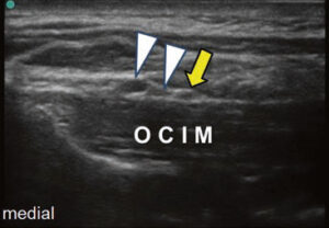 OCIM, obliquus capitis inferior muscle, sonoanatomy, ultrasound, greater occipital nerve, GON, greater occipital nerve block