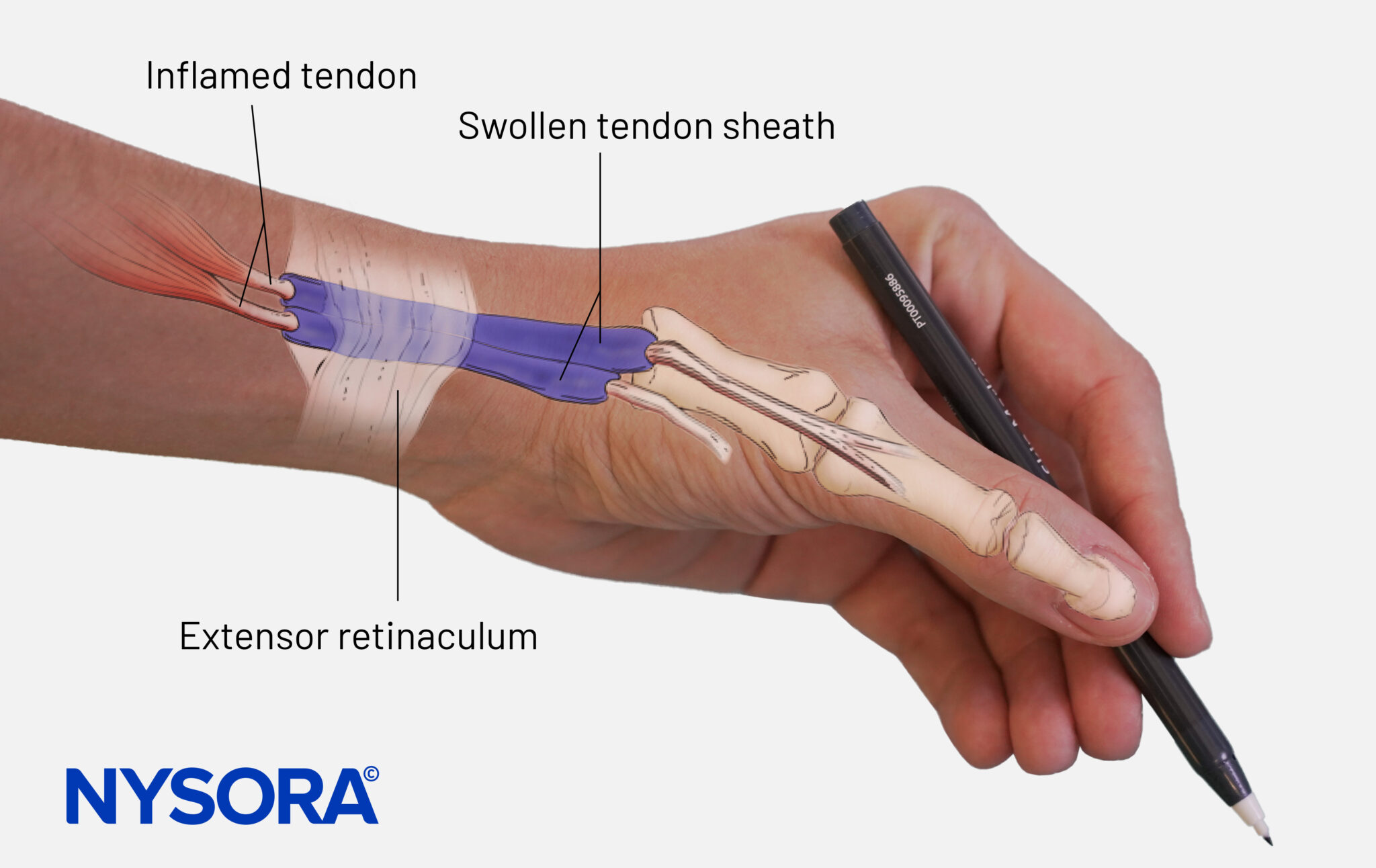 Patient Case Study De Quervain s Tenosynovitis Injection NYSORA 