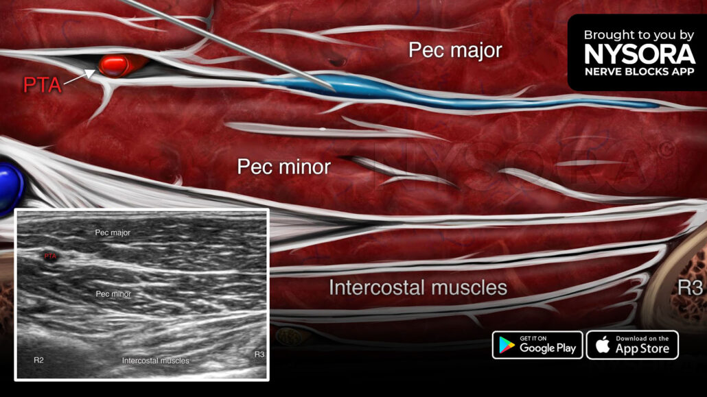 Pecs Block Local Anesthetic at Homer Bautista blog