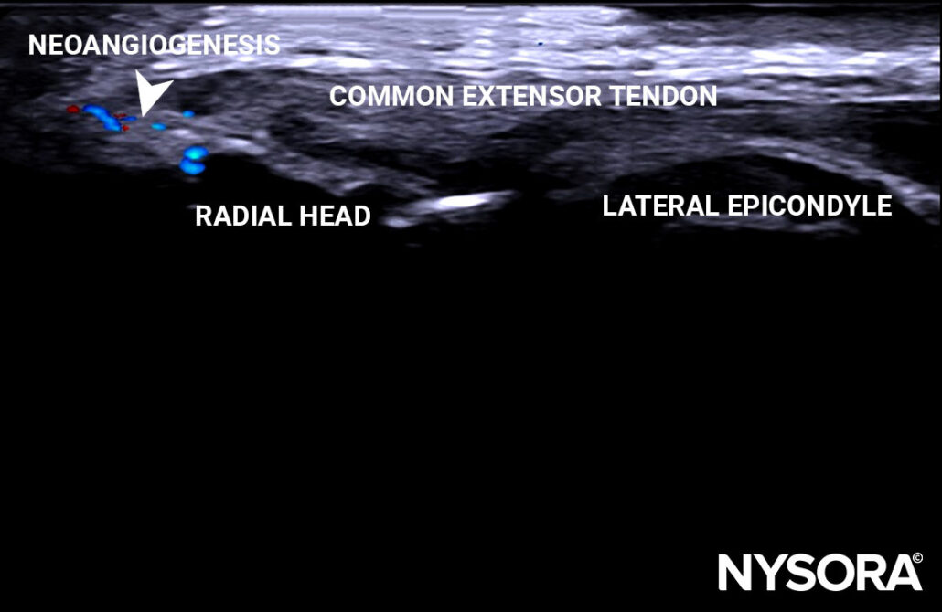 Case study Lateral epicondylitis Injection NYSORA
