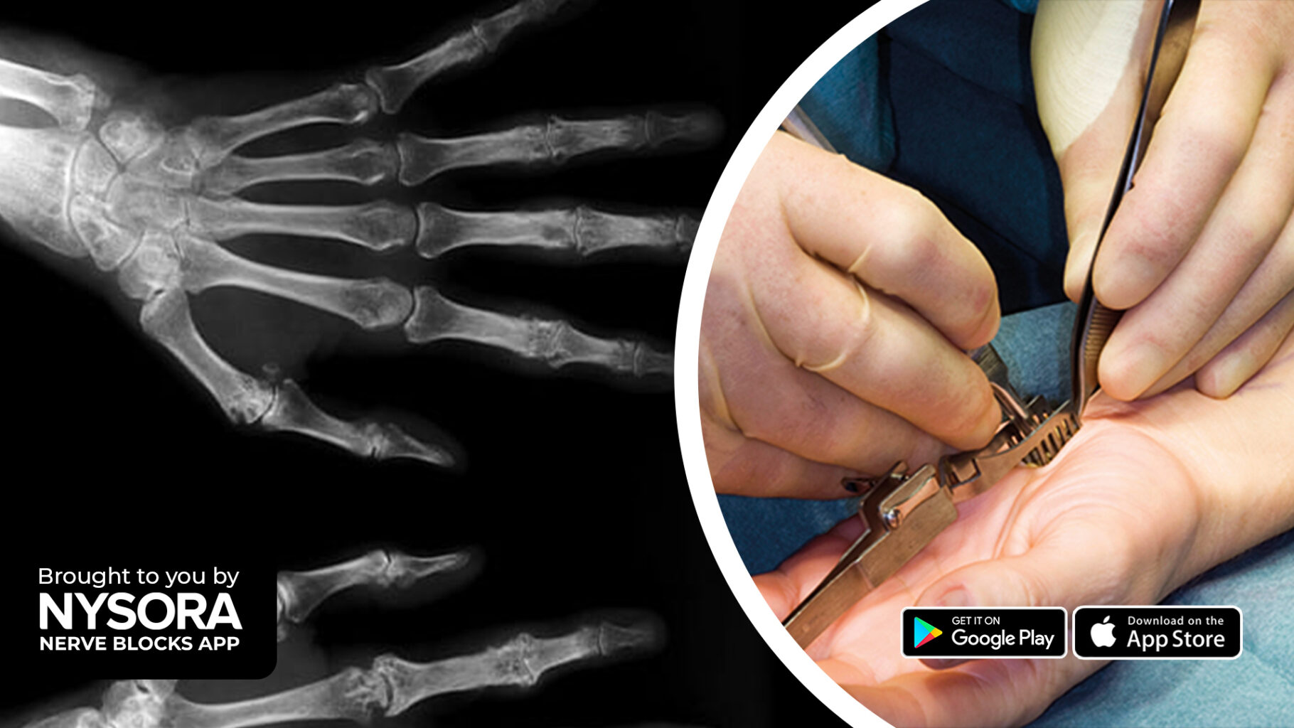 Case study Carpal Tunnel Release 25 July NB app NYSORA NYSORA