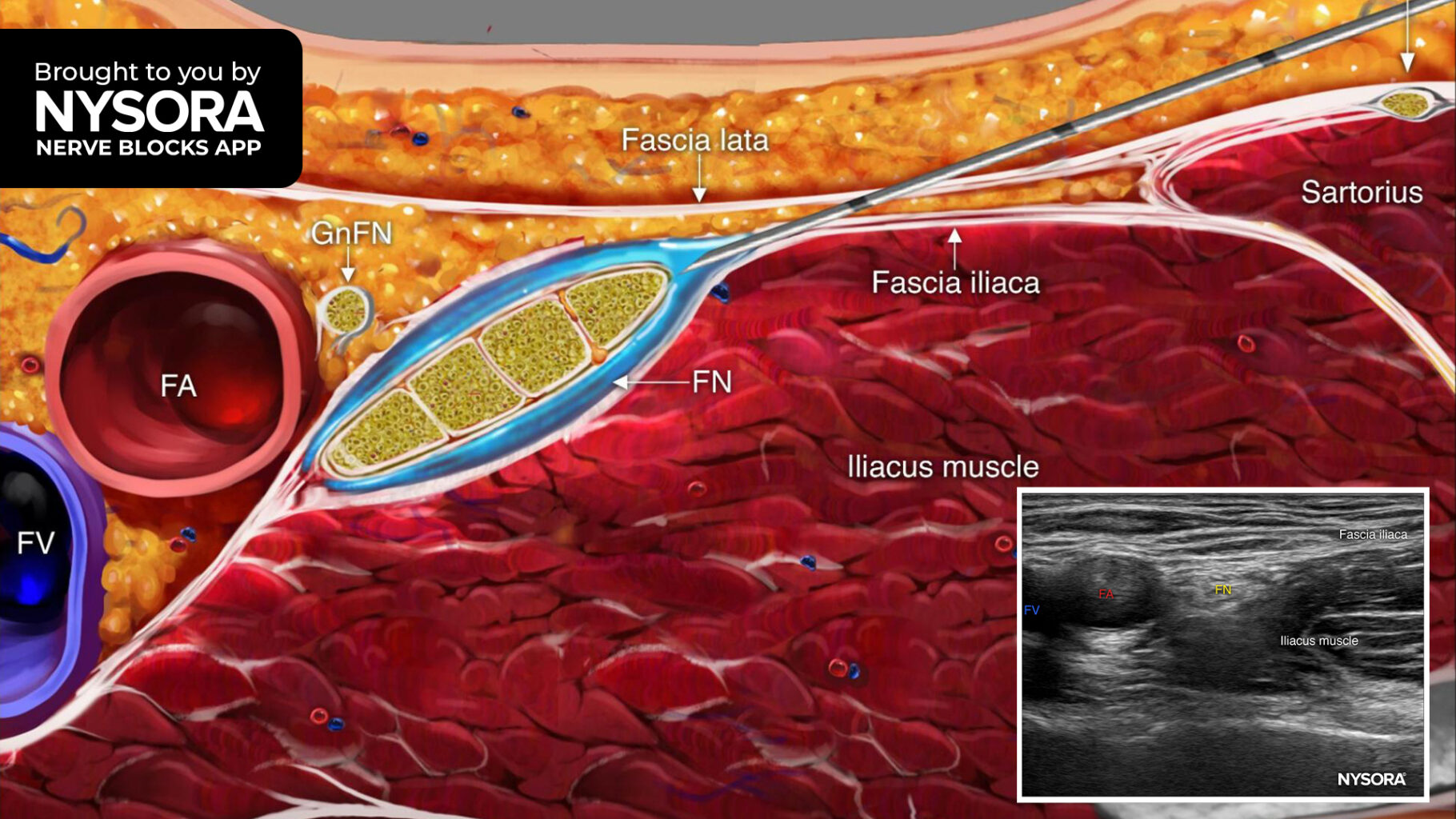 Tips for a Femoral Nerve Block NYSORA NYSORA