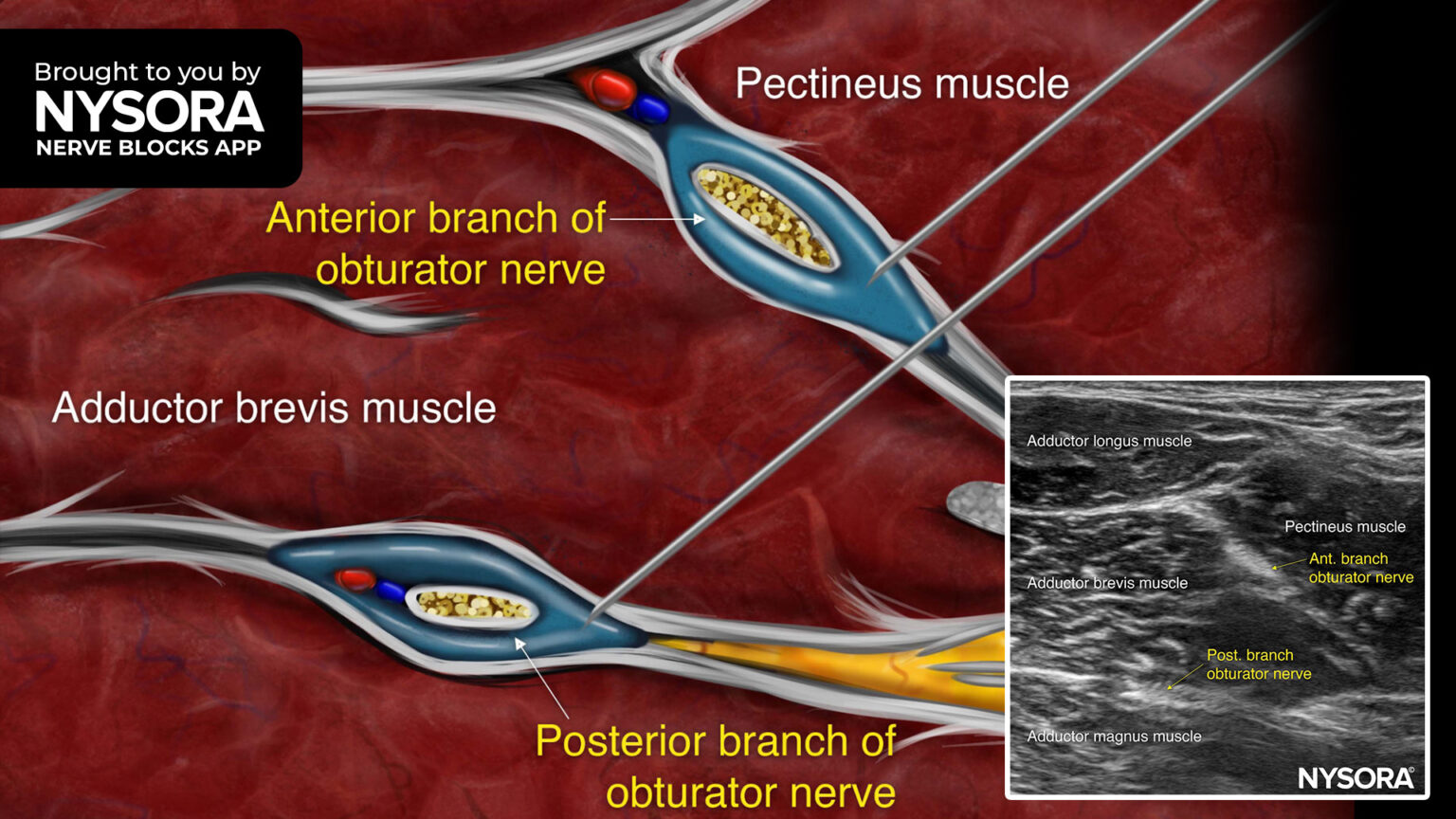 Tips for an Obturator Nerve Block Distal Approach NYSORA NYSORA