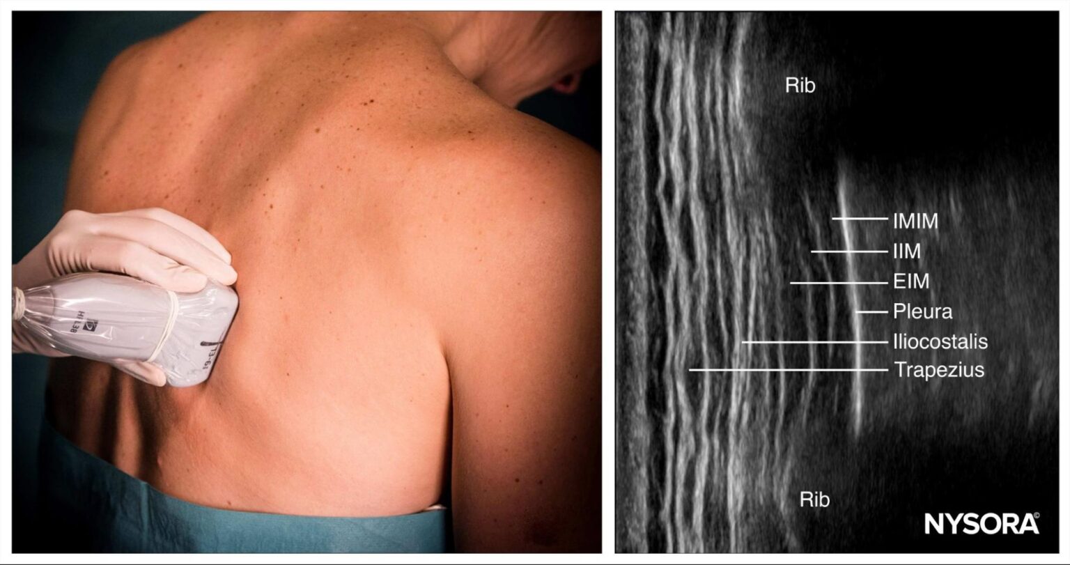 Case study UltrasoundGuided Intercostal Nerve Block for PostHerpetic