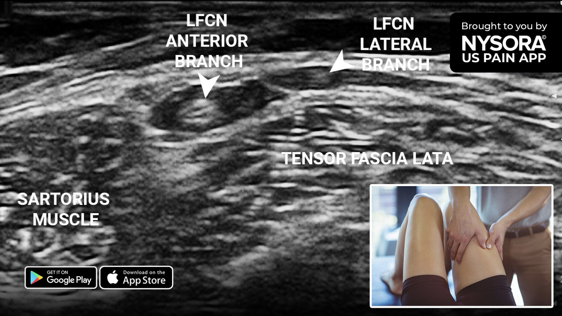 Case study Meralgia paresthetica Injection NYSORA