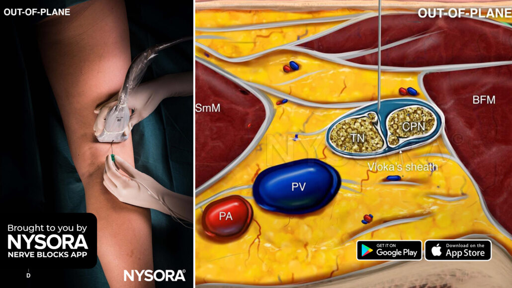 Lower Extremity Nerve Blocks Poster (in) – NYSORA