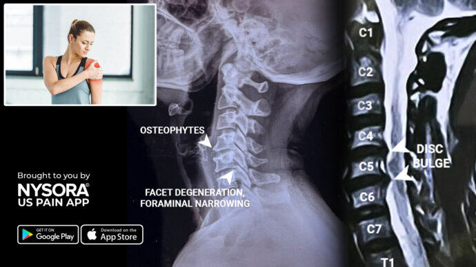 Case study: Cervical radiculopathy – Injection