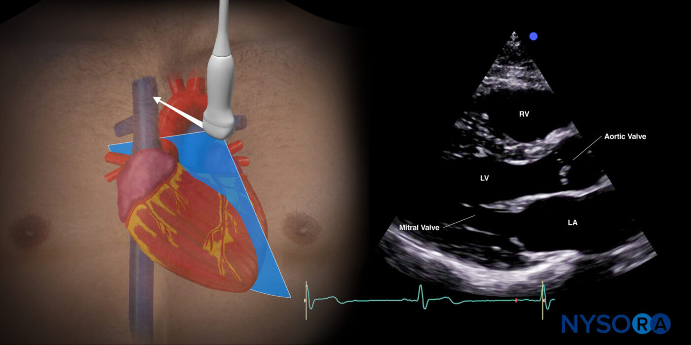 Clinical case: Left ventricular function - NYSORA