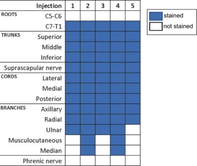 New Insights Into The Spread Of Costoclavicular Brachial Plexus Block