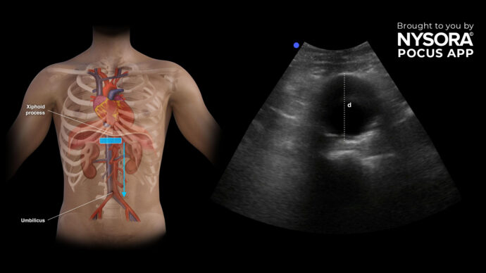 新 POCUS 课程：腹主动脉瘤 (AAA)