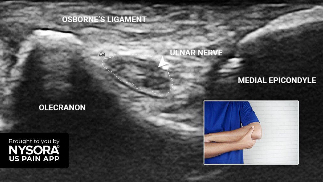 Case study: Cubital tunnel syndrome - Injection - NYSORA