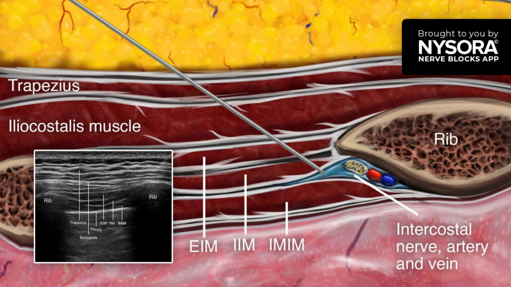 Tips for an Intercostal Nerve Block NYSORA