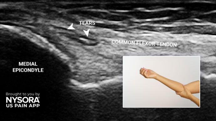 Case study: Golfer’s elbow – Injection