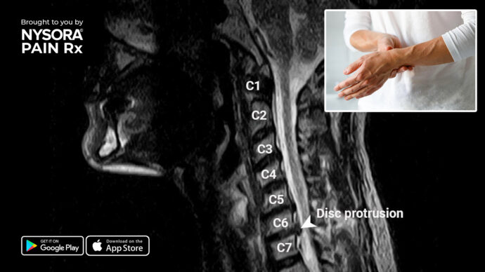 Case study: Cervical hernia with radicular pain